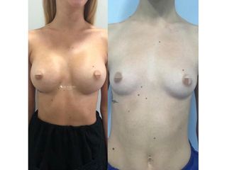 Aumento de pecho - Dr. Quintero