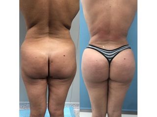 Liposucción - Dr. Quintero
