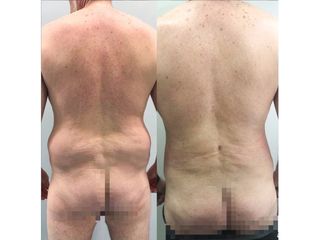 Liposucción - Dr. Quintero