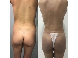 Liposucción - Dr. Quintero