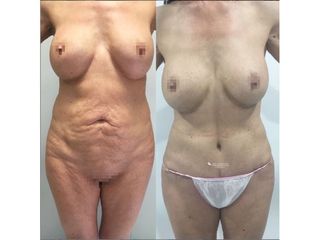 Abdominoplastia - Dr. Quintero