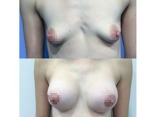 Aumento de pecho - Dr. Quintero