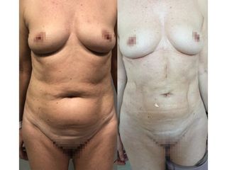 Abdominoplastia - Dr. Quintero