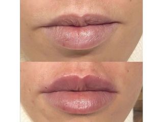 Aumento de labios - Dr. Quintero