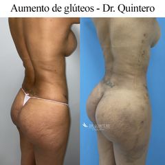 Aumento de glúteos - Dr. Quintero