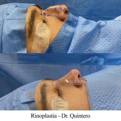 Rinoplastia - Dr. Quintero