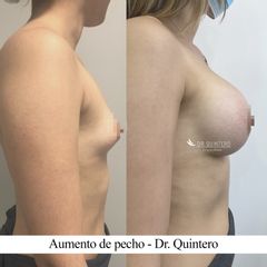 Aumento de pecho - Dr. Quintero