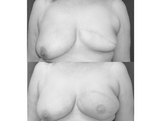Antes y después Reconstrucción de mama