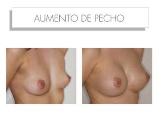 Antes y después Aumento de pecho