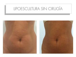 Antes y después lipoescultura sin cirugía 
