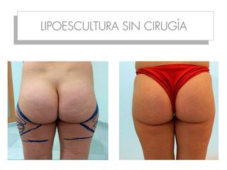 Antes y después LIPOESCULTURA SIN CIRUGÍA - LIPOVASER