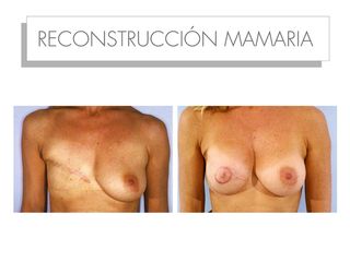 Antes y después Reconstrucción mamaria