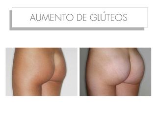 Antes y después AUMENTO DE GLÚTEOS