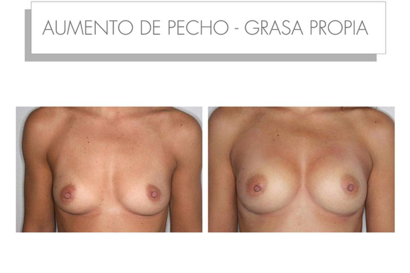 Lipofilling antes y después - 565203
