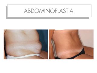Antes y después ABDOMINOPLASTIA