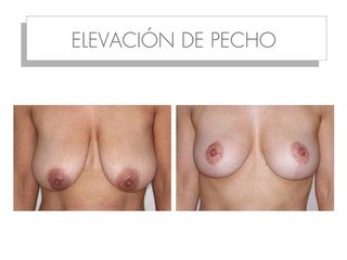 Antes y después mastopexia 