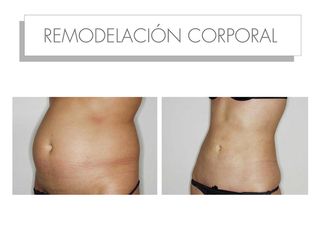 Antes y después REMODELACIÓN CORPORAL