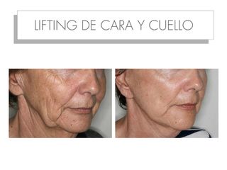 Antes y después LIFTING DE CARA Y CUELLO