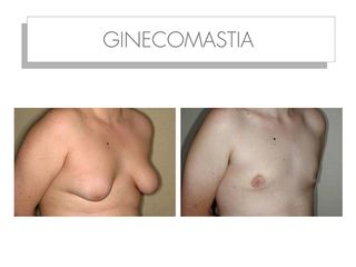 Antes y después GINECOMASTIA
