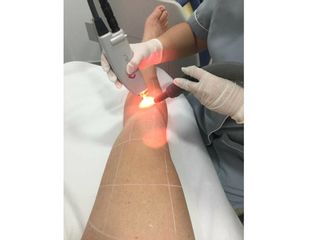 depilación Láser