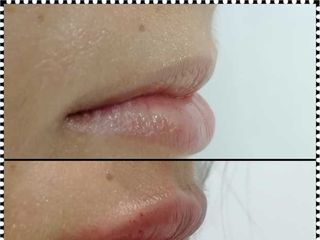 Antes y después Perfilado de labios hialurónico 