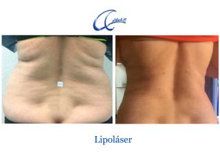 Antes y después Lipoláser