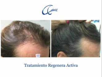 Tratamiento capilar - 644993