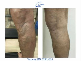 Tratamiento varices - 644995