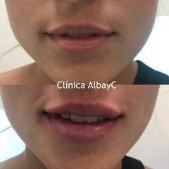 Aumento de labios - ClinicaAlbayC