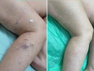 Tratamiento varices - 797509
