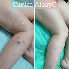 Tratamiento varices - ClinicaAlbayC