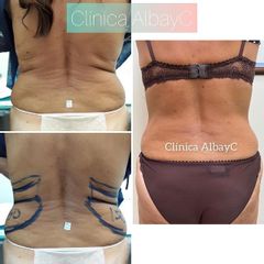 Lipoláser - ClinicaAlbayC