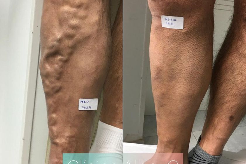 Tratamiento varices antes y después - 812108