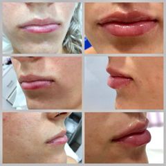 Aumento de labios - Dr. Roberto Ramírez