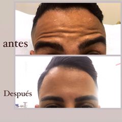 Rellenos faciales - Dr. Roberto Ramírez