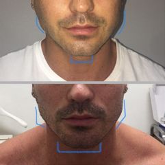 Masculinización facial - Dr. Roberto Ramírez