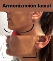 Armonización facial - Dr. Roberto Ramírez