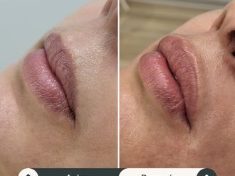 Aumento labios antes y después - 870093