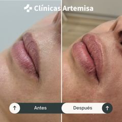 Aumento de labios - Clínicas Artemisa