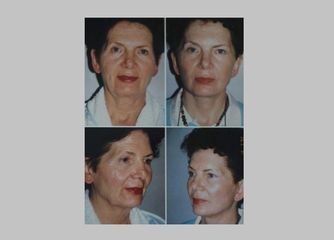 Antes y después Rejuvenecimiento facial