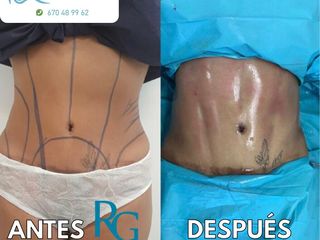 Antes y después MARCACIÓN ABDOMINAL