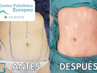Antes y después LIPOLASER ABDOMINAL Y MARCACIÓN ABDOMINAL