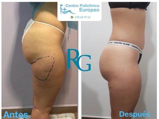 Antes y después Lipoláser