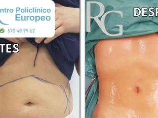 Antes y después Lipoláser