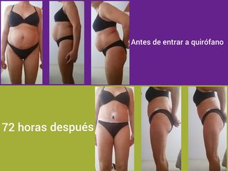 Liposucción - 649452