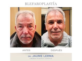 Antes y después Blefaroplastia