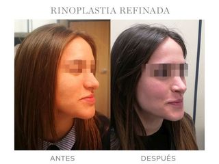 Antes y después Rinoplastia - Dr. Jaume Lerma Goncé