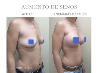 Antes y después Aumento de pecho - Dr. Jaume Lerma Goncé