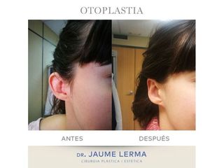 Antes y después Otoplastia - Dr. Jaume Lerma Goncé