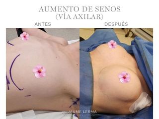Antes y después Aumento de pecho - Dr. Jaume Lerma Goncé